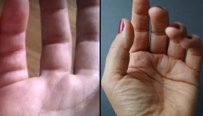 Research: Few People Have Extra Creases On Their Little Fingers
