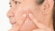 Solusi Medis dan Alami Mengatasi Jerawat Batu Paling Efektif