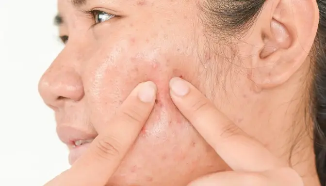 Solusi Medis dan Alami Mengatasi Jerawat Batu Paling Efektif